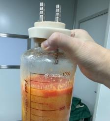 银川水动力吸脂手术要做多久？